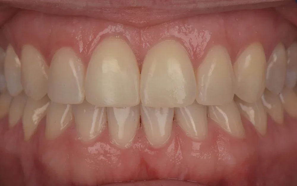 After treatment