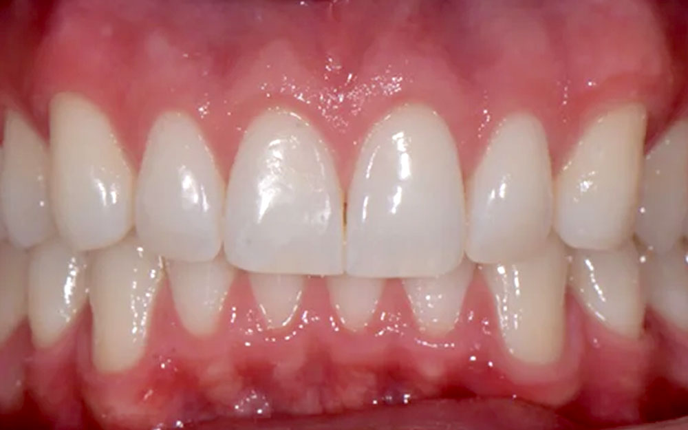 After treatment