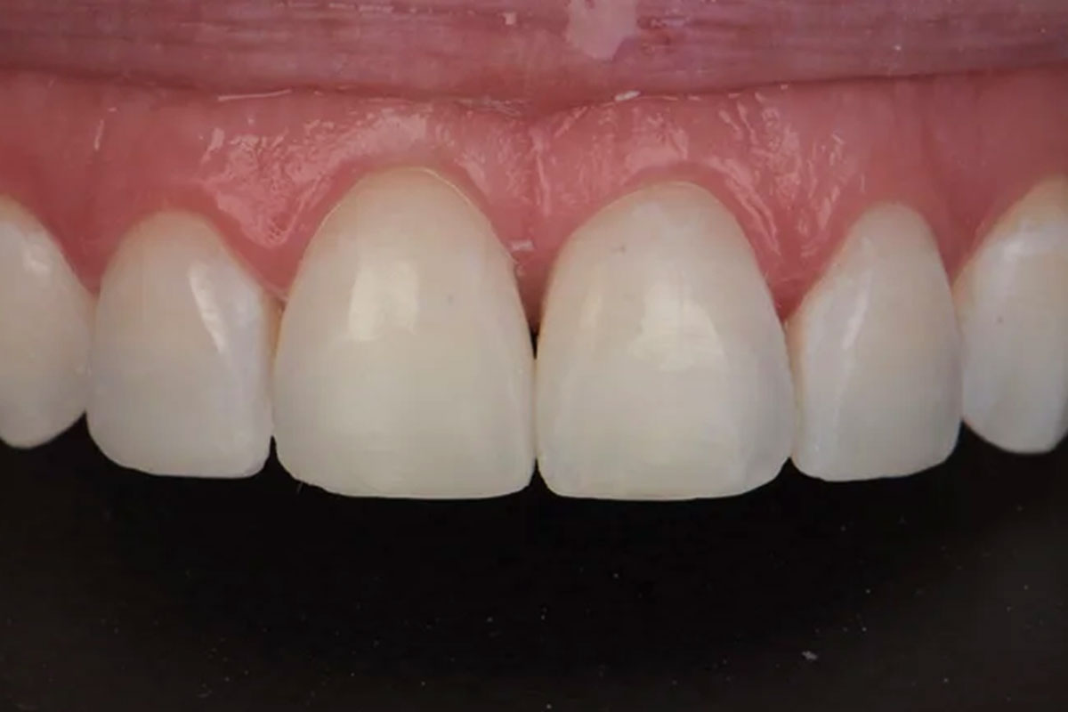 After treatment