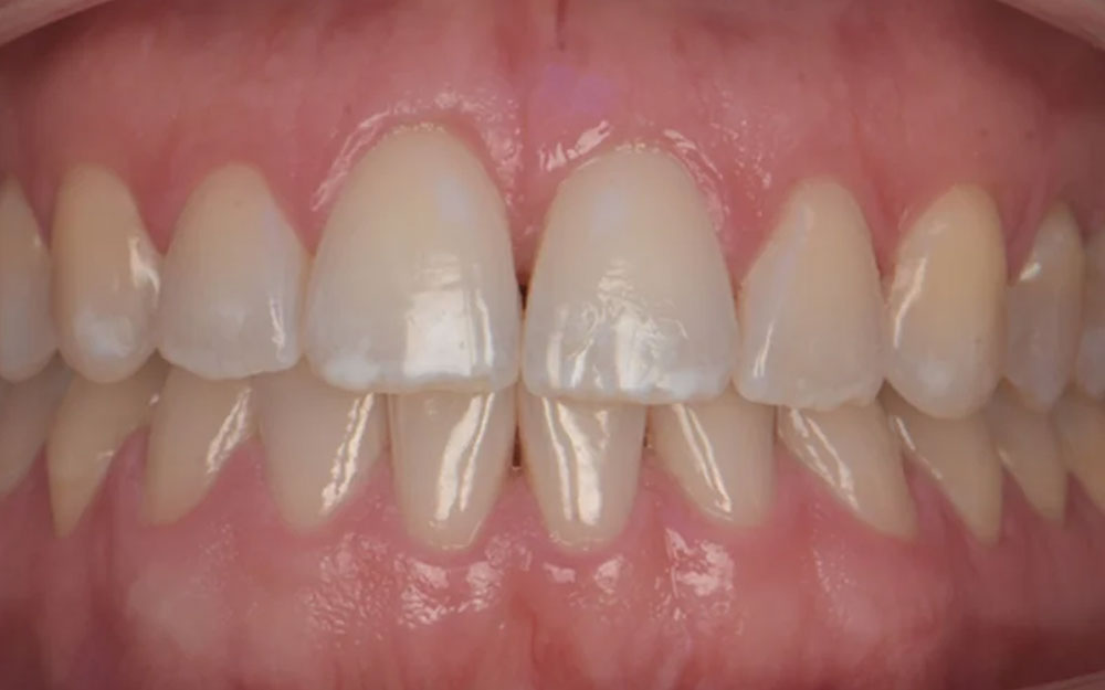 Before treatment