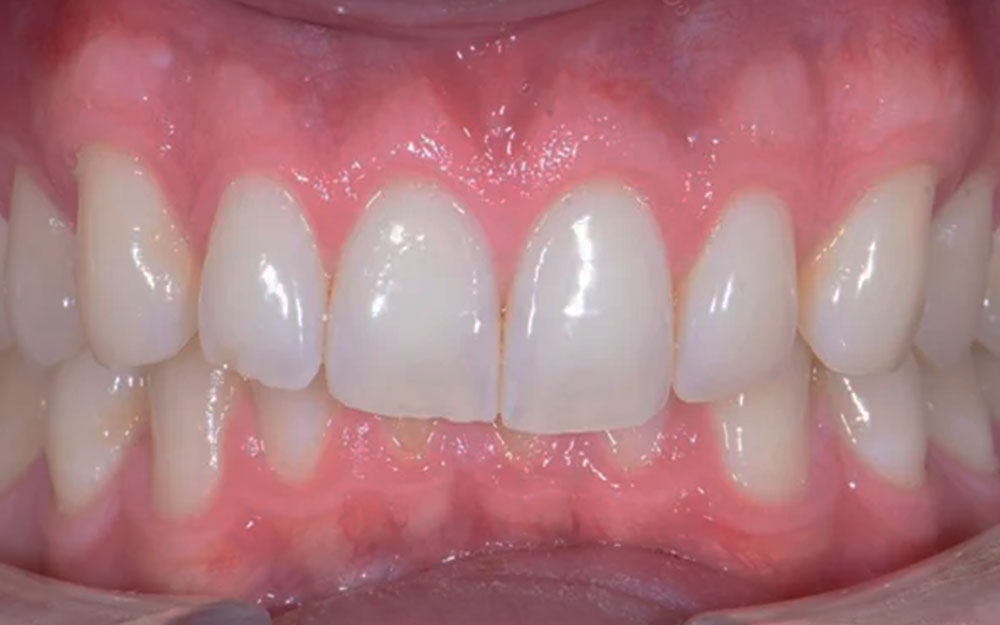 Before treatment