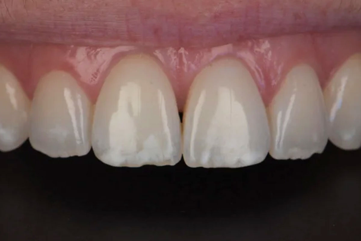 Before treatment