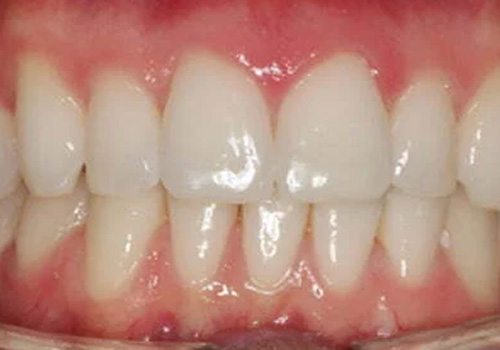 After treatment