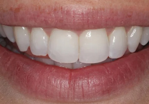 After treatment