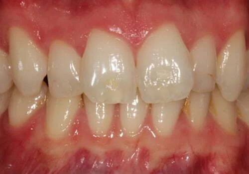 Before treatment