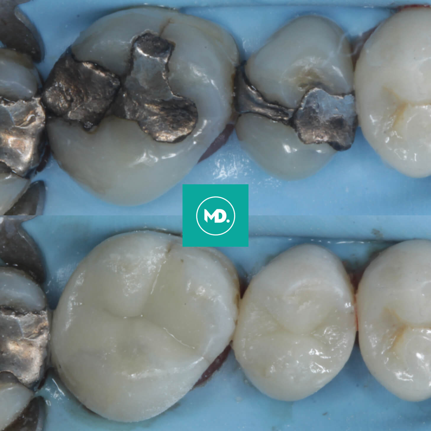 White Fillings Edinburgh Composite Fillings Invisible Fillings