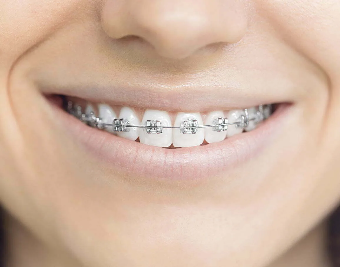 Fixed Braces Edinburgh Private Dental Practice Invisalign Edinburgh
